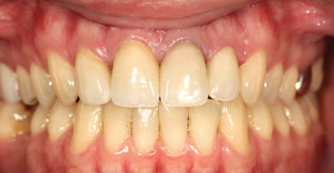 The image shows a close-up view of a person's mouth with teeth showing signs of decay and discoloration, indicating poor oral hygiene.