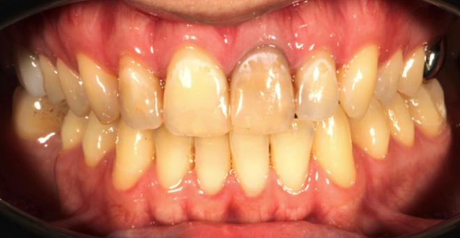 The image shows a close-up view of a person's teeth with yellowing and staining, particularly noticeable on the bottom teeth, which are crowded together. A partial denture is visible on the upper right side. The teeth appear to be in need of professional cleaning or dental care.