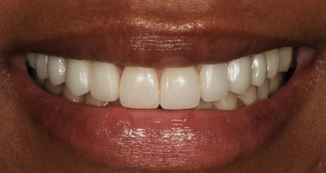 The image shows a close-up of a person s smiling mouth with white teeth and red lipstick, set against a blurred background.