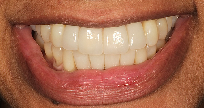 The image shows a person smiling with their teeth prominently displayed, which appear yellowed.