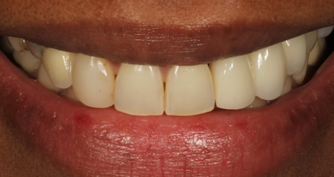 The image shows a close-up of a person with a radiant smile, displaying straight white teeth and red gums, against a blurred background.