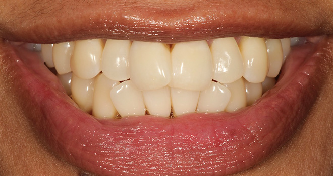 The image shows a person with a broad smile, displaying yellowed teeth and a red lipstick mark, set against a neutral background.