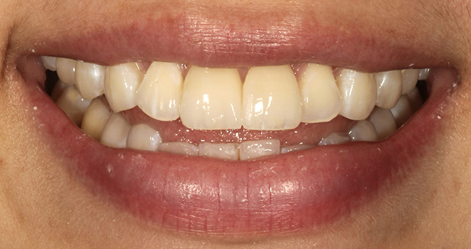 Chroma Dental | ZOOM  Whitening, Cosmetic Dentistry and Cosmetic Smile Makeover