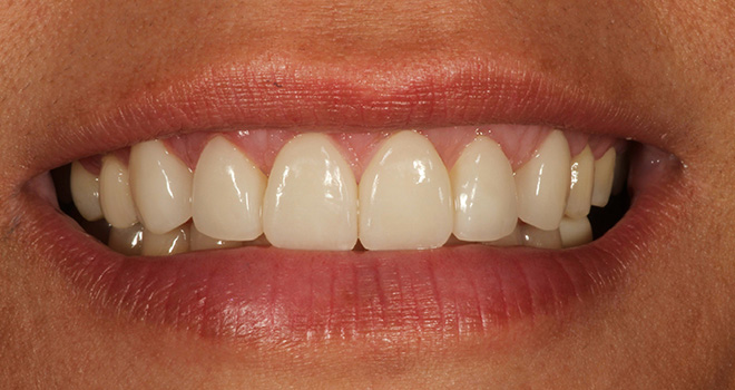 The image shows a close-up view of a person's smiling mouth with straight white teeth.