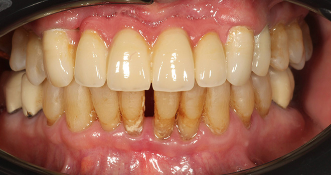 The image displays a close-up view of a person's teeth with visible yellowing, staining, and decay, which indicates poor oral hygiene and potential dental issues.