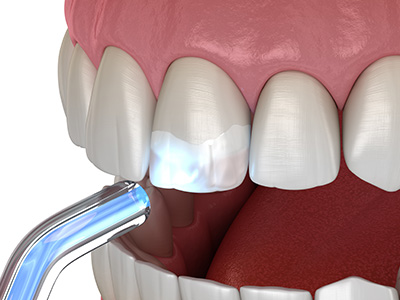 Chroma Dental | Periodontal Treatment, All-on-6 reg  and Oral Exams