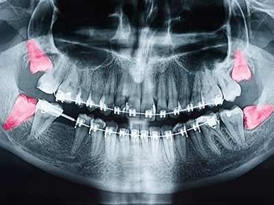 Chroma Dental | Ceramic Crowns, Dentures and Sleep Apnea