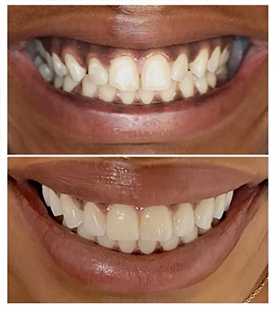 Chroma Dental | Night Guards, Invisalign reg and Full Mouth Reconstruction