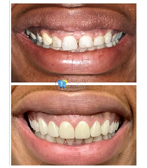 Chroma Dental | Teeth Whitening, All-On-X Teeth in a day and Digital Radiography