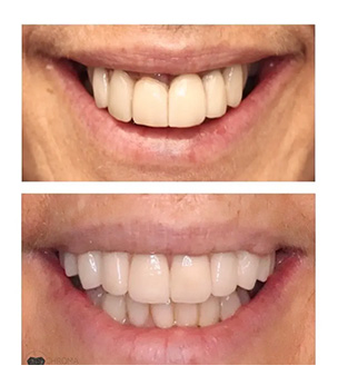 Chroma Dental | TMJ Disorders, Dentures and Veneers