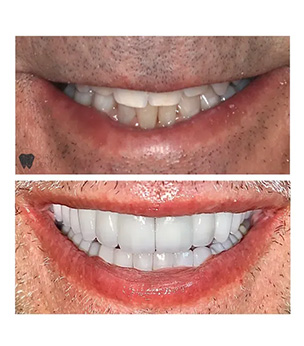 Chroma Dental | CEREC, Laser Dentistry and Extractions