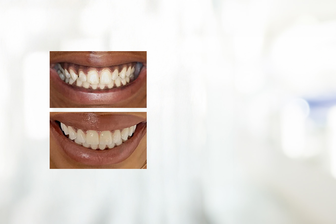 Chroma Dental | Dental Fillings, Intraoral Camera and Dental Bridges