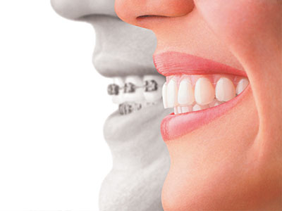 Chroma Dental | Preventative Program, Night Guards and Veneers