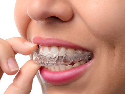 Chroma Dental | Oral Surgery, Fluoride Treatment and Veneers