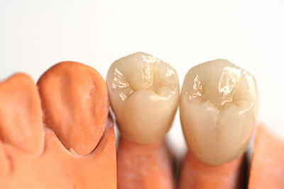 Chroma Dental | Dental Bridges, Snoring Appliances and Dermal Fillers