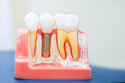 Chroma Dental | Inlays  amp  Onlays, Cosmetic Smile Makeover and Ceramic Crowns