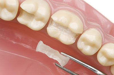 Chroma Dental | Extractions, Snoring Appliances and TMJ Disorders