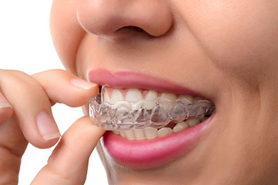 Chroma Dental | Dental Sealants, Implant Dentistry and All-On-X  Teeth in a day 