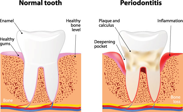 Chroma Dental | Night Guards, Veneers and Dental Cleanings