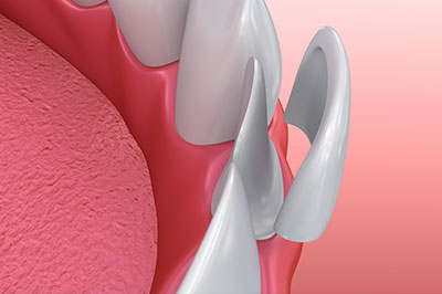 Chroma Dental | ZOOM  Whitening, Wisdom Teeth and Extractions