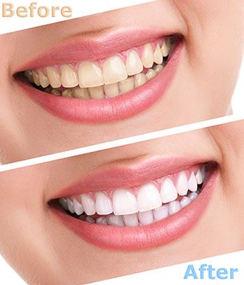 Chroma Dental | Sedation Dentistry, All-On-X  Teeth in a day  and CEREC