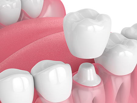 Chroma Dental | Periodontal Treatment, Wisdom Teeth and Implant Dentistry
